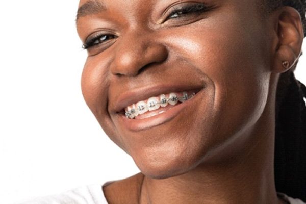 trad-braces-1 trad-braces-1